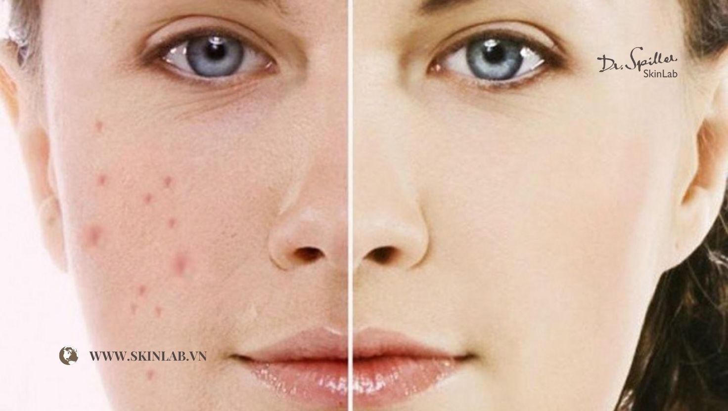xu hướng chăm da phục hồi sau mụn