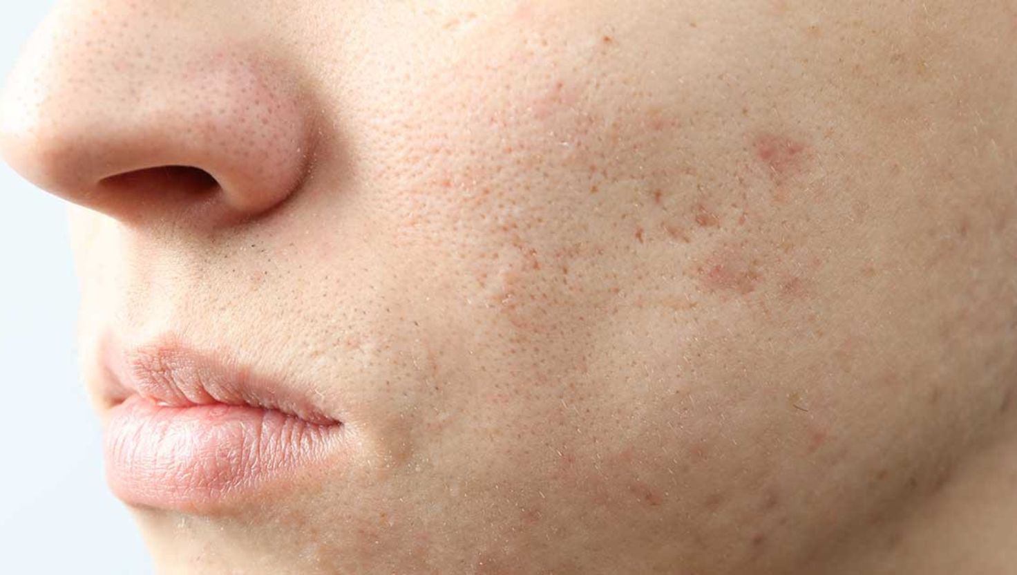 Các vấn đề thường gặp ở làn da sau mụn