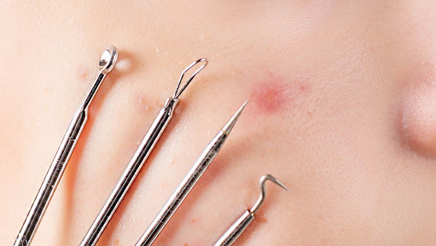 Các lưu ý quan trọng khác khi phục hồi da sau mụn
