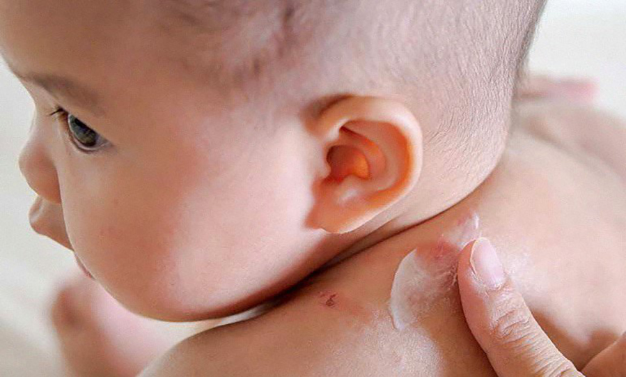 Khi thời tiết chuyển lạnh, da trẻ rất dễ bị tổn thương, gây ra tình trạng rát đỏ, khô nẻ và bong tróc khiến bé khó chịu