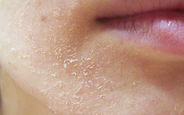 Da nứt nẻ chảy máu mùa đông xuất phát từ nhiều yếu tố, chủ yếu liên quan đến thời tiết lạnh và hanh khô kéo dài