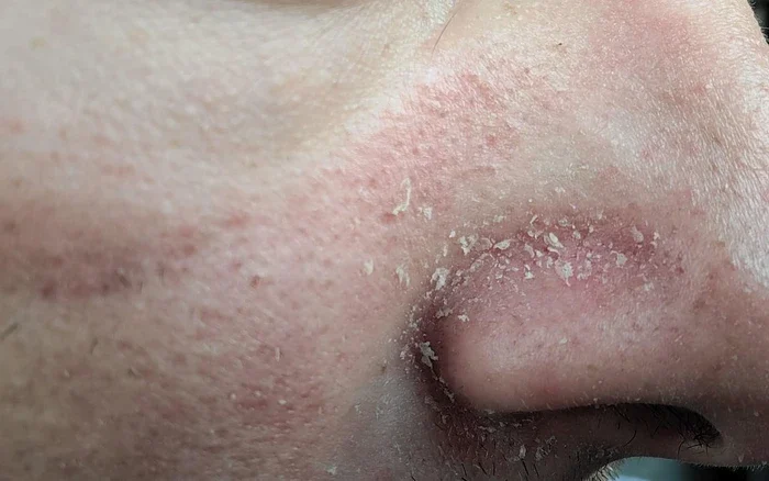 Để giữ được làn da mềm mại và khỏe mạnh trong giai đoạn giao mùa, việc hiểu rõ làm sao để da không bị bong tróc khi giao mùa là điều cần thiết.