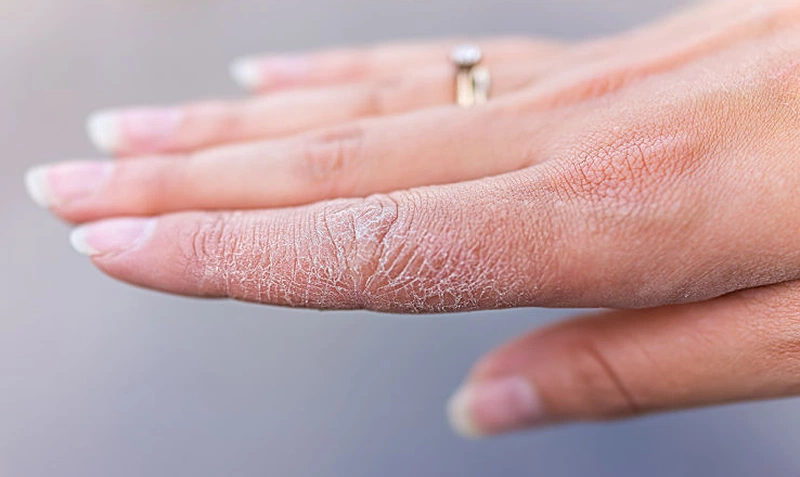 Làn da mỏng manh ở tay rất dễ bị mất độ ẩm, khiến da trở nên khô ráp, đau rát và bong tróc.