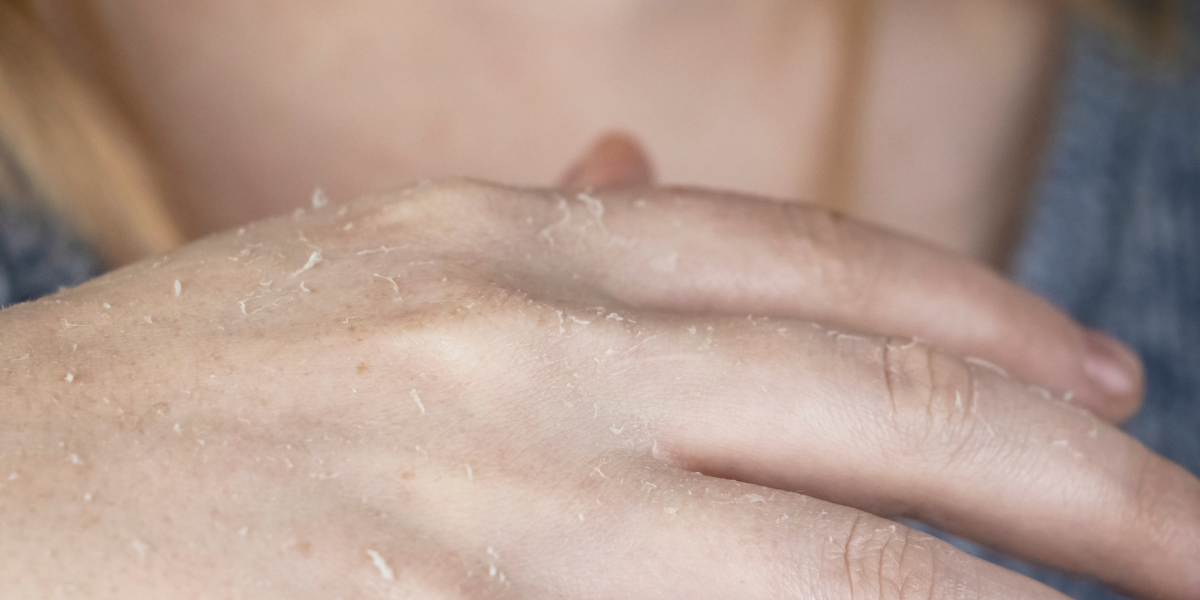 Tăng cường độ ẩm và tái tạo lớp biểu bì bị tổn thương do nứt nẻ da tay mùa thu