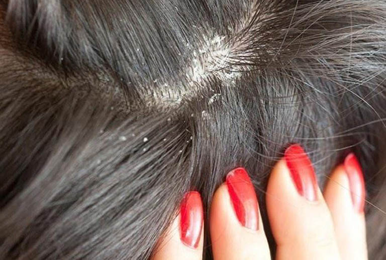 Gàu và ngứa da đầu là những vấn đề phổ biến gây khó chịu và ảnh hưởng không nhỏ đến ngoại hình của nhiều người