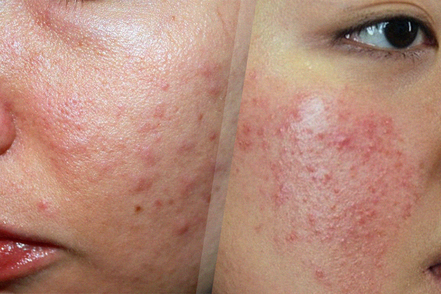 Lưu ý quan trọng khi chăm sóc da dễ kích ứng mùa nồm