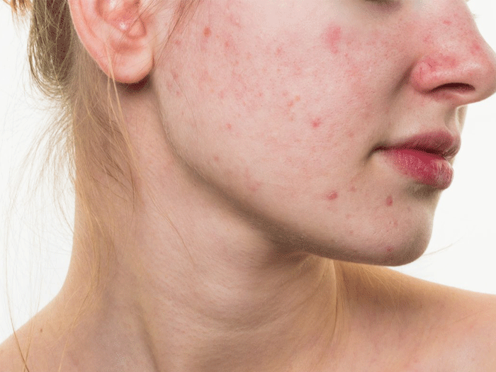 Skinlab là một trong những spa chuyên sâu hàng đầu chuyên hỗ trợ điều trị các vấn đề về da, đặc biệt tình trạng da nổi mụn do thời tiết nồm