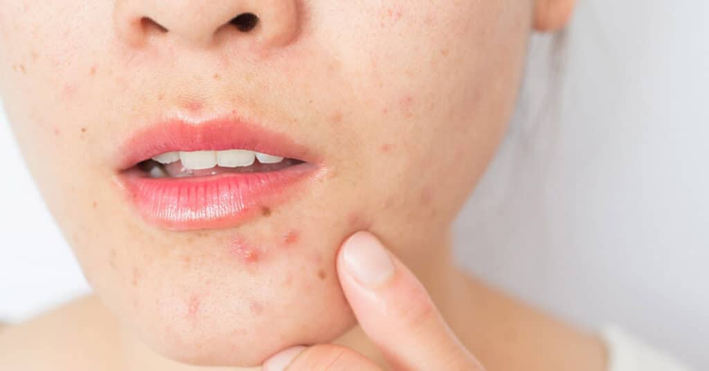 Da nổi mụn do thời tiết nồm không phải là tình trạng không thể kiểm soát nếu bạn biết cách làm đúng và đủ