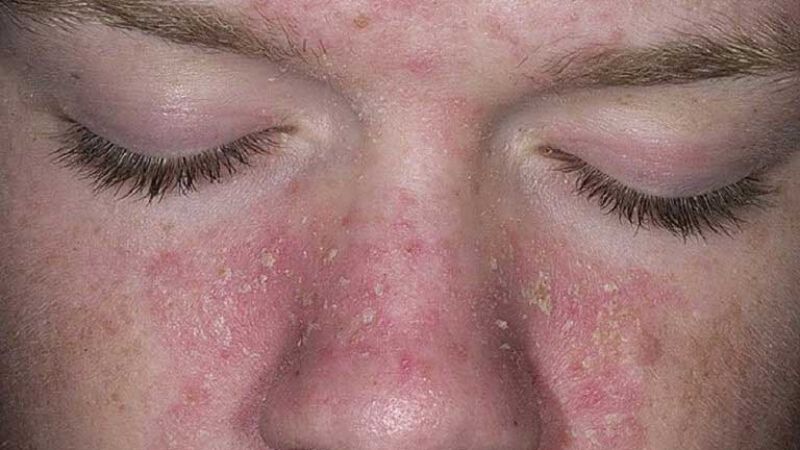 Da tiết bã nhờn mùa nồm là hiện tượng phổ biến do sự thay đổi môi trường độ ẩm cao tạo điều kiện thuận lợi cho tuyến bã hoạt động mạnh mẽ hơn.