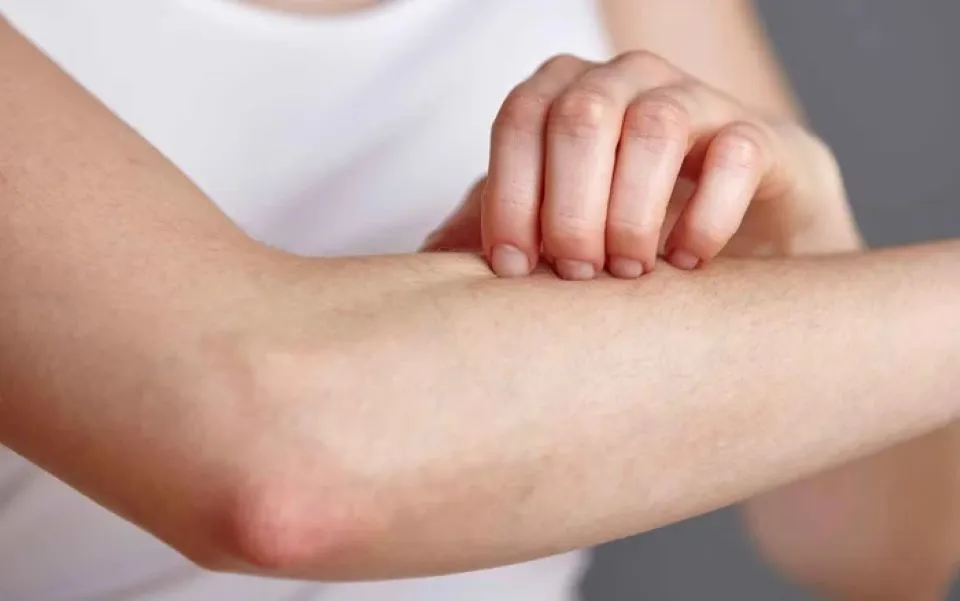 Dị ứng da mùa nồm thường bắt nguồn từ việc tăng cao độ ẩm trong không khí tạo điều kiện thuận lợi cho vi khuẩn