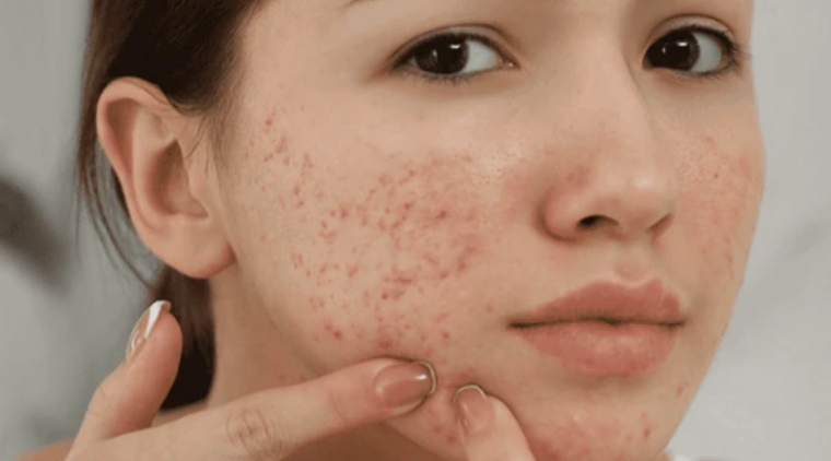 Mụn mùa nồm thường xuất hiện do đặc điểm thời tiết ẩm ướt kết hợp nhiệt độ thay đổi thất thường