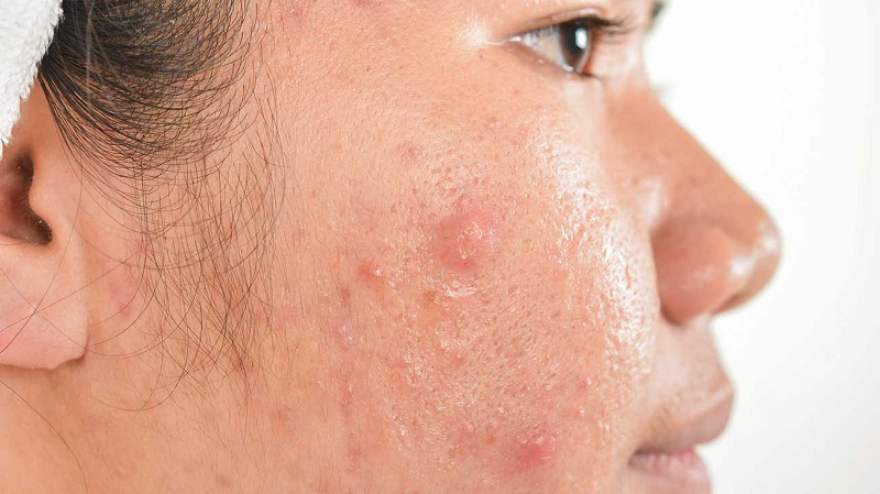 chăm sóc mụn mùa nồm tại nhà thường giúp kiểm soát tình trạng nhưng chưa đủ để xử lý triệt để các vấn đề viêm da phát sinh do độ ẩm cao