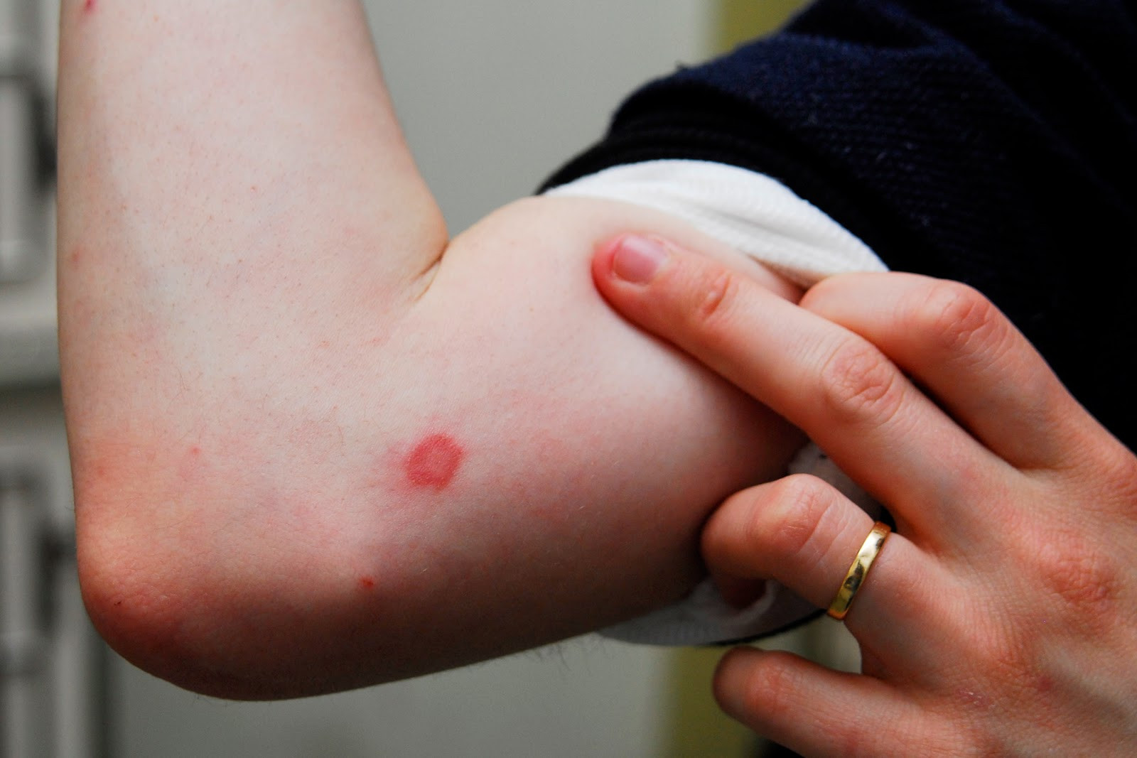 Viêm da mùa nồm không chỉ là tình trạng đơn giản, mà cần được xử lý kịp thời và chuyên sâu để tránh tổn thương lâu dài cho da