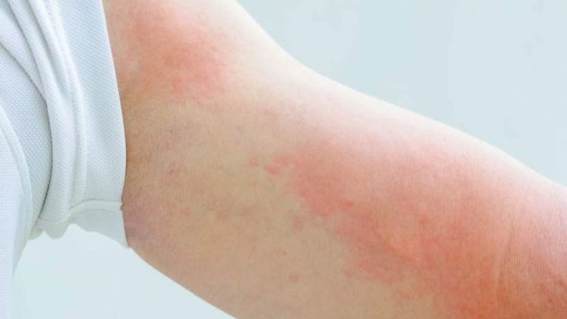 mỗi người có thể bảo vệ mình khỏi viêm da mùa nồm – một trong những vấn đề da liễu phổ biến trong thời tiết ẩm ướt.