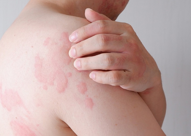 Duy trì một chế độ chăm sóc da phù hợp giúp củng cố lớp bảo vệ tự nhiên cần thiết để hạn chế các phản ứng ngứa ngáy và khó chịu ở da.