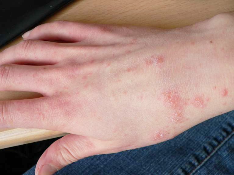 Mùa nồm với đặc tính độ ẩm cao và thời tiết thay đổi thất thường đòi hỏi chúng ta phải chú ý hơn trong việc bảo vệ làn da