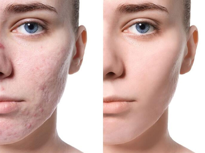 Tìm kiếm các phương pháp trị sẹo lồi hiệu quả luôn thu hút sự quan tâm đặc biệt