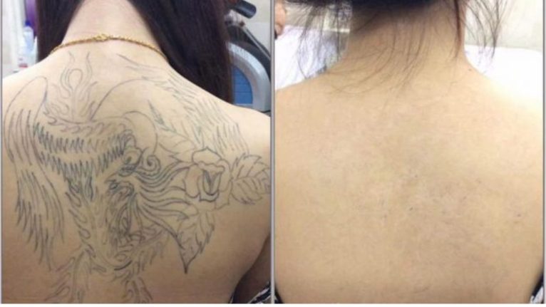 Dịch vụ spa Quảng Ninh xóa xăm đang ngày càng được nhiều người lựa chọn nhằm loại bỏ những hình xăm không còn phù hợp