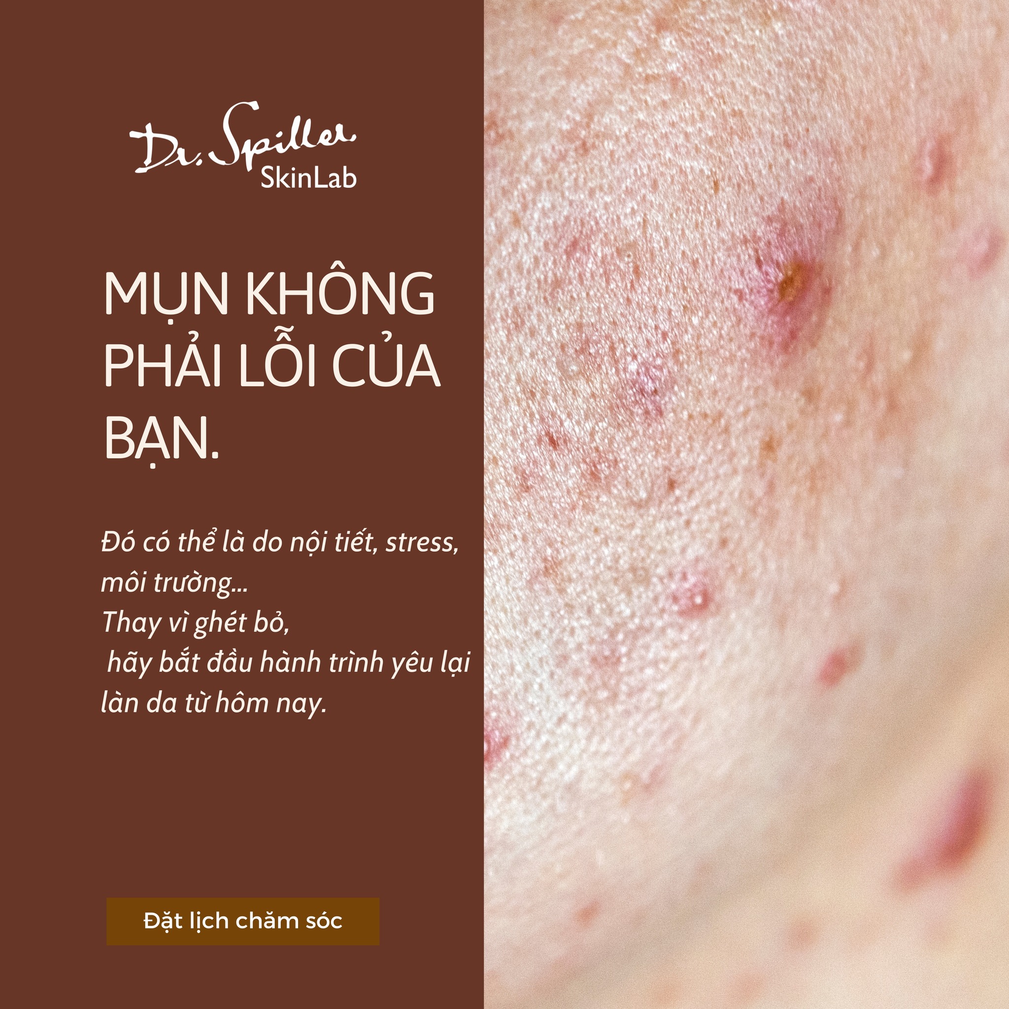 lựa chọn spa trị mụn không để lại sẹo HCM ngày càng trở nên cần thiết để mang lại hiệu quả cao và an toàn cho làn da.