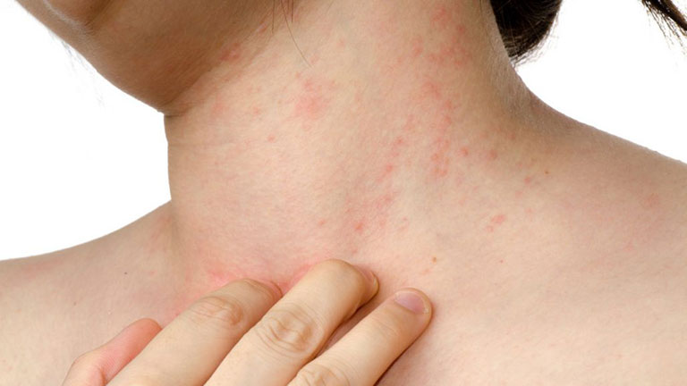Da mẩn đỏ mùa thu là tình trạng xảy ra khá phổ biến do thời tiết chuyển mùa, khiến làn da nhạy cảm trở nên yếu và dễ tổn thương