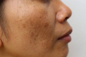 Bài viết này sẽ cung cấp thông tin chuyên sâu nhằm giúp bạn nhìn nhận đúng vấn đề và chăm sóc da hợp lý khi gặp phải tình trạng da sạm màu mùa thu.