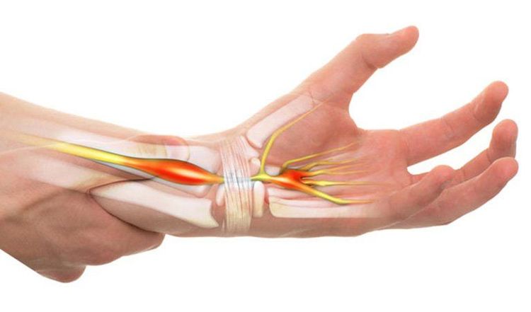 Hội chứng ống cổ tay là một bệnh lý phổ biến ảnh hưởng sâu sắc đến cuộc sống của nhiều người