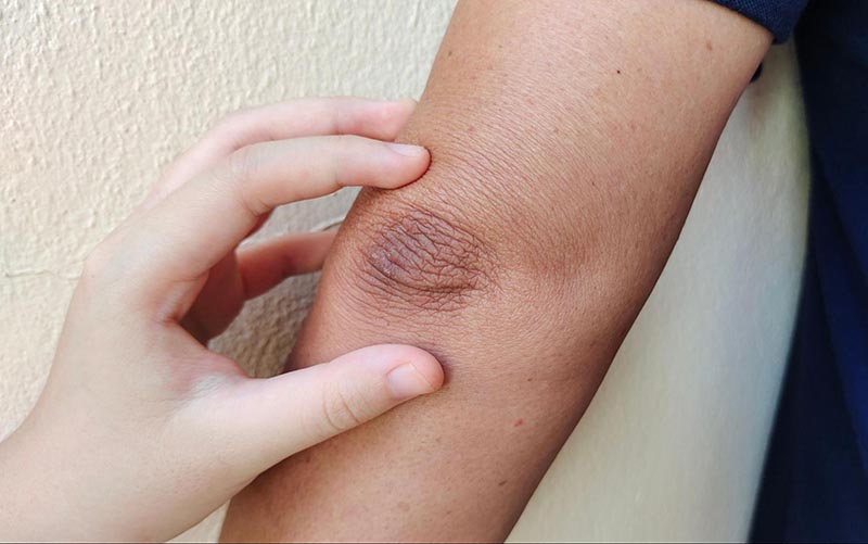 Trong bài viết, chúng ta sẽ cùng khám phá những cách trị thâm khuỷu tay có thể áp dụng để cải thiện vùng da này một cách an toàn và hiệu quả.