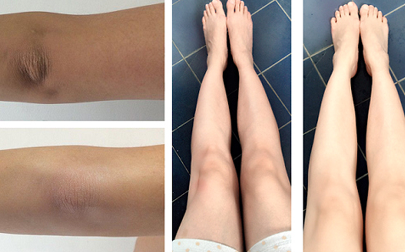chăm sóc da đầu gối đúng cách không chỉ giúp cải thiện tình trạng da mà còn góp phần nâng cao vẻ đẹp tổng thể của làn da trên cơ thể.