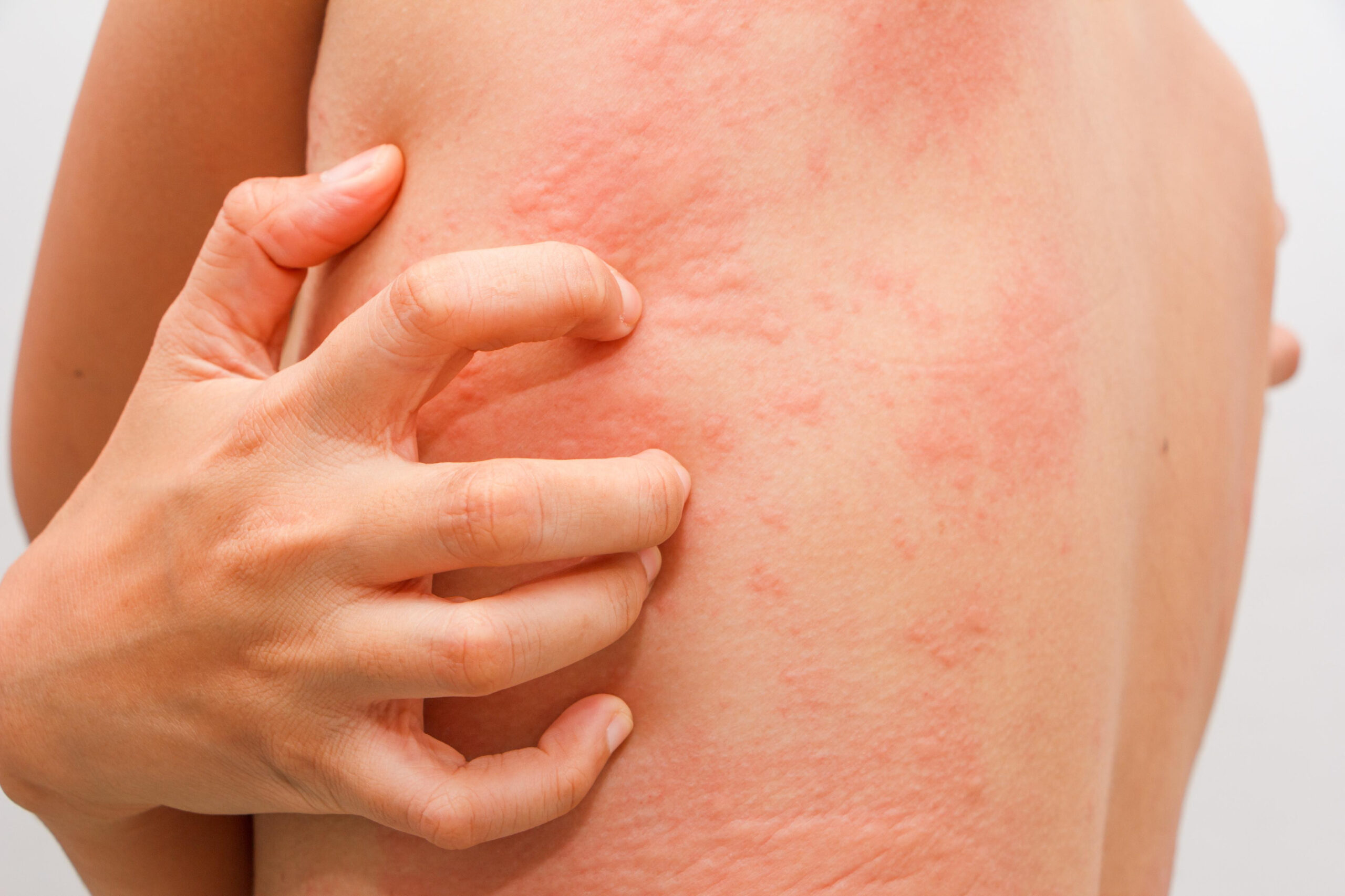 Da body bị ngứa là tình trạng thường gặp, gây ra cảm giác khó chịu và ảnh hưởng trực tiếp đến chất lượng cuộc sống