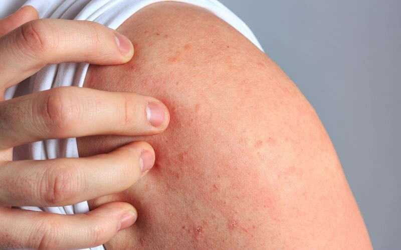 Để cải thiện tình trạng da khô ngứa trên toàn thân, việc đầu tiên là giữ cho da luôn duy trì độ ẩm đầy đủ.
