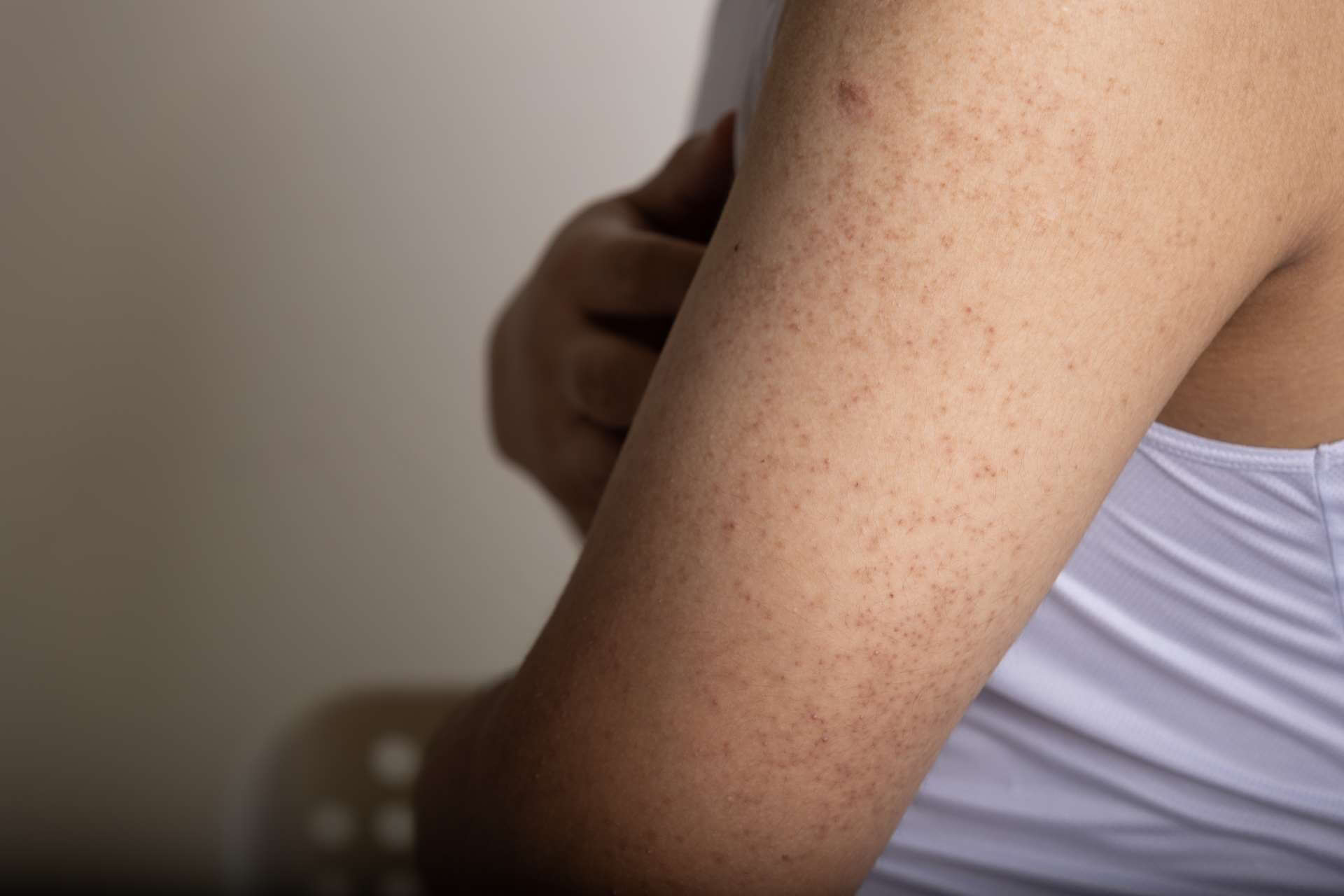 Tình trạng da body bị sần là một biểu hiện khá phổ biến khiến nhiều người cảm thấy khó chịu và mất tự tin trong sinh hoạt hàng ngày