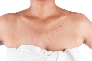Để cải thiện da body bị thâm cần bắt đầu từ việc làm sạch dịu nhẹ và tẩy da chết đều đặn