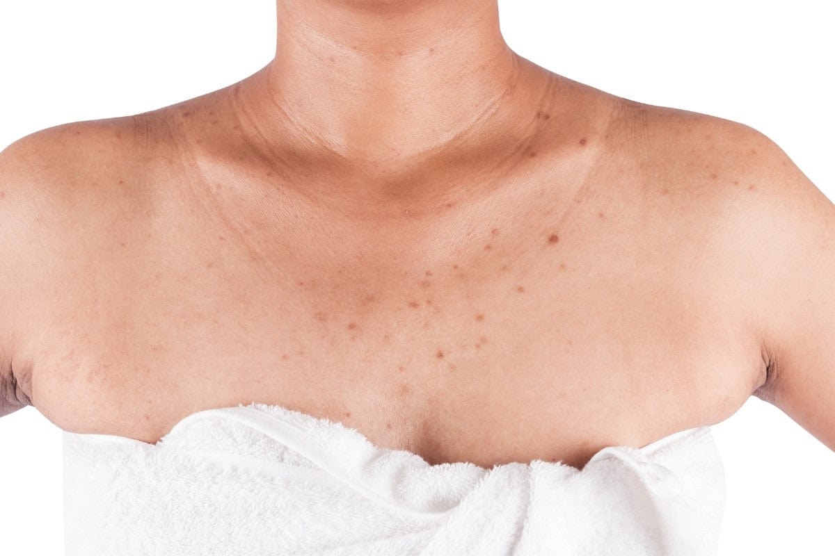 Để cải thiện da body bị thâm cần bắt đầu từ việc làm sạch dịu nhẹ và tẩy da chết đều đặn