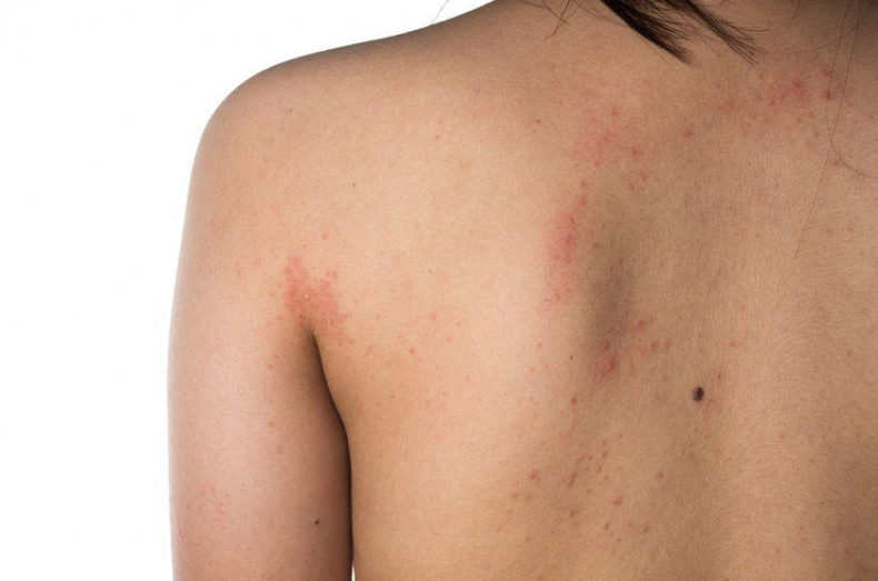 Da body nổi mẩn đỏ là hiện tượng thường gặp và gây ra cảm giác ngứa ngáy, khó chịu cho nhiều người.