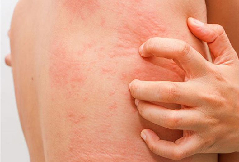 Việc đầu tiên khi thấy da body nổi mẩn đỏ là cần loại bỏ tác nhân kích thích gây mẩn như ngưng sử dụng sản phẩm mới