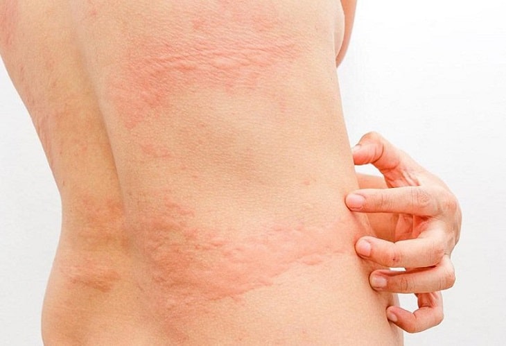 Bảo vệ và duy trì một làn da khỏe mạnh sau khi da body nổi mẩn đỏ đòi hỏi sự kiên nhẫn và lựa chọn phù hợp trong thói quen chăm sóc hàng ngày.
