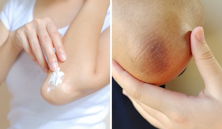 chăm sóc đều đặn và cẩn thận vùng da thâm khuỷu tay không chỉ hạn chế tình trạng thâm thêm nặng mà còn giúp nuôi dưỡng da trở nên mềm mại và sáng khỏe theo thời gian