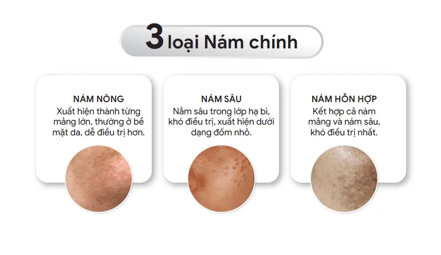 nhận biết đúng các loại nám da sẽ giúp quy trình chăm sóc và điều trị phù hợp, tối ưu hiệu quả, giảm thiểu nguy cơ tái phát.