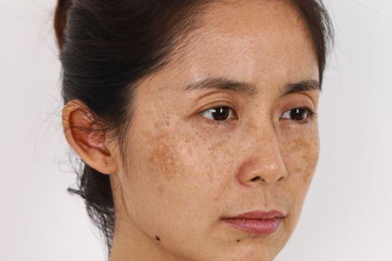 Để giải quyết tận gốc vấn đề nám da, không chỉ dừng lại ở việc nhận biết mà còn cần có phương pháp điều trị phù hợp với từng loại sắc tố da.