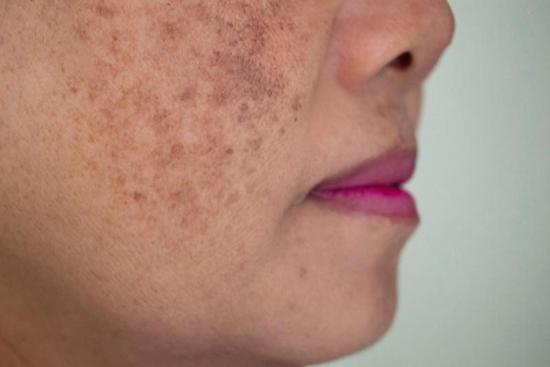 hiểu rõ các loại rối loạn sắc tố da, nguyên nhân gây ra cũng như cách chăm sóc phù hợp là điều cần thiết để có thể phòng ngừa và xử lý hiệu quả