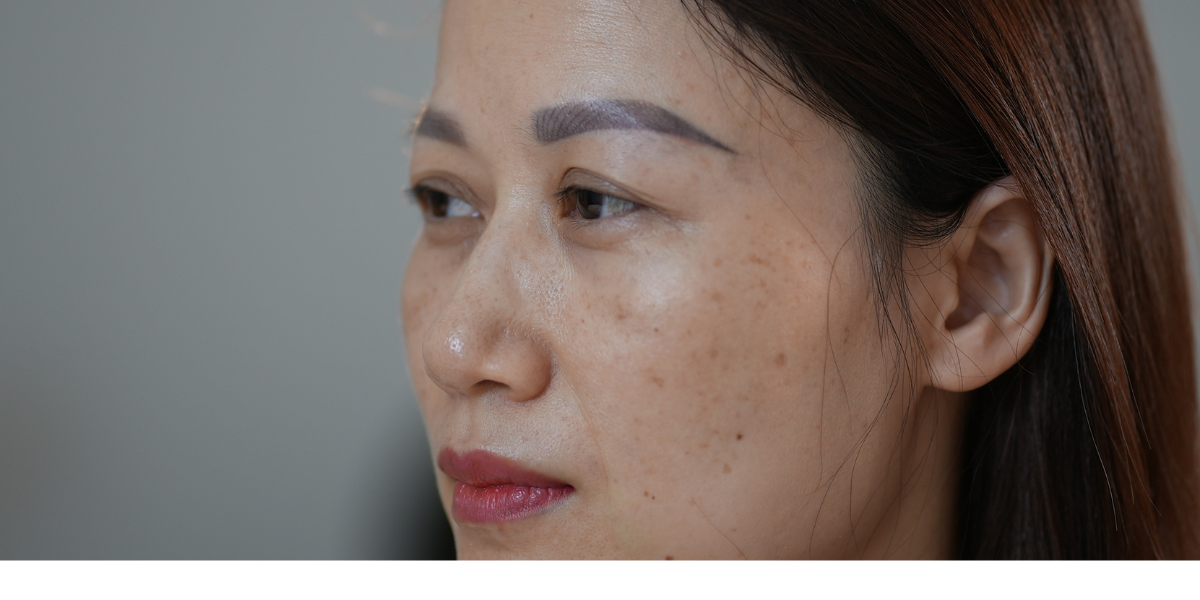 Một số phương pháp điều trị tại spa, dùng laser, peel da sinh học kết hợp với chăm sóc tại nhà khoa học có thể mang lại hiệu quả tốt hơn.