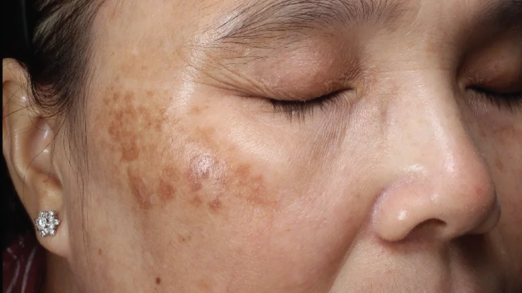 tình trạng nám có thể dễ dàng tái phát nếu không có biện pháp bảo vệ hiệu quả và thường xuyên duy trì thói quen chăm sóc da phù hợp.