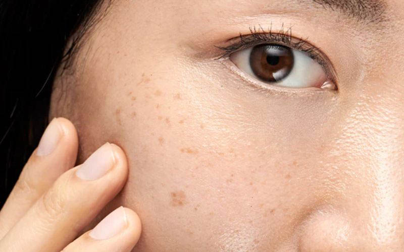 Sau quá trình trị nám, việc duy trì dưỡng da đúng cách và bảo vệ da khỏi ánh nắng là hết sức cần thiết để kết quả lâu dài