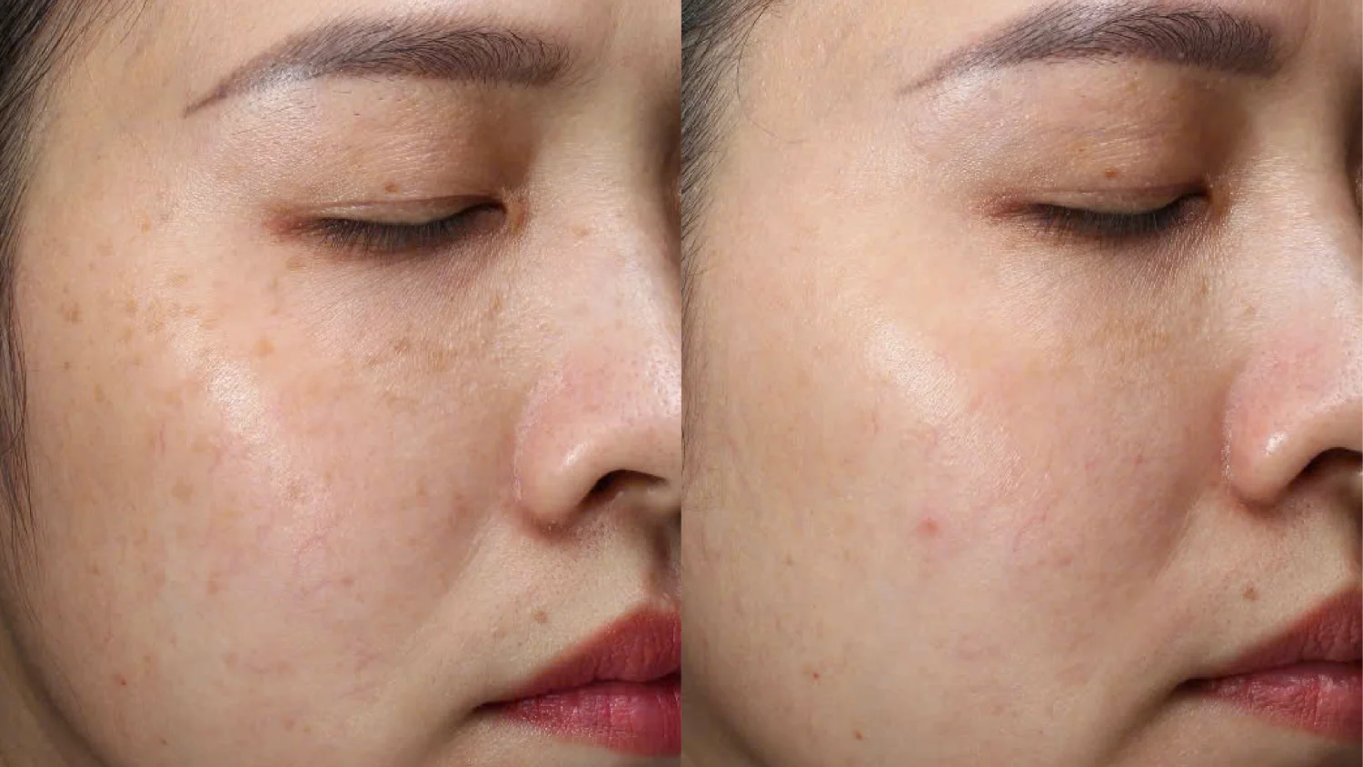 chăm sóc da sau điều trị nám là cả một quá trình đòi hỏi sự kiên nhẫn và chú ý tỉ mỉ đến từng khâu để bảo vệ và nuôi dưỡng làn da hiệu quả