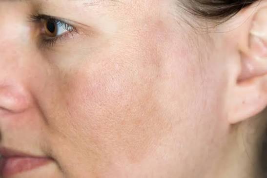 Da bị sạm đen và không đều màu là tình trạng thường gặp, gây ảnh hưởng đến vẻ ngoài và sự tự tin của nhiều người