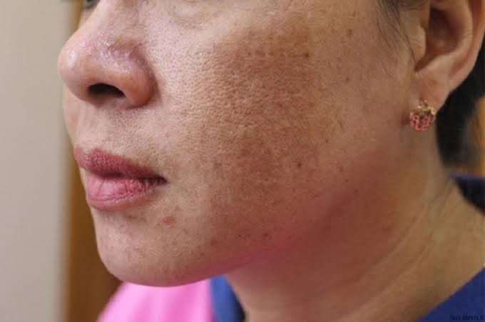 chăm sóc khi da bị tăng sắc tố nhằm hạn chế tối đa tác động từ ánh nắng và kích thích sản xuất melanin quá mức