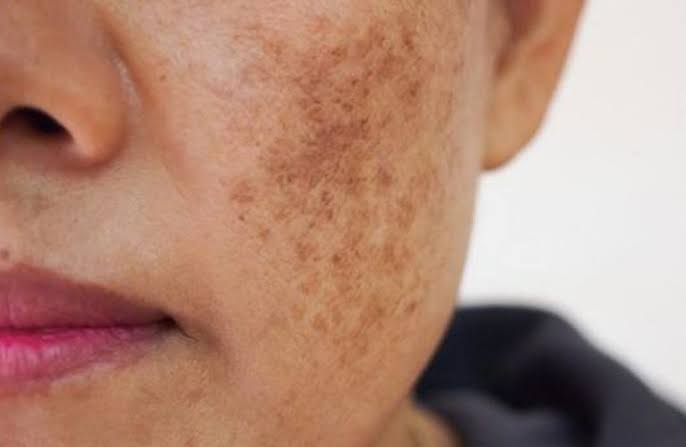 Hiểu được da xuất hiện đốm nâu nguyên nhân do đâu giúp chúng ta chọn lựa được biện pháp phòng ngừa và chăm sóc