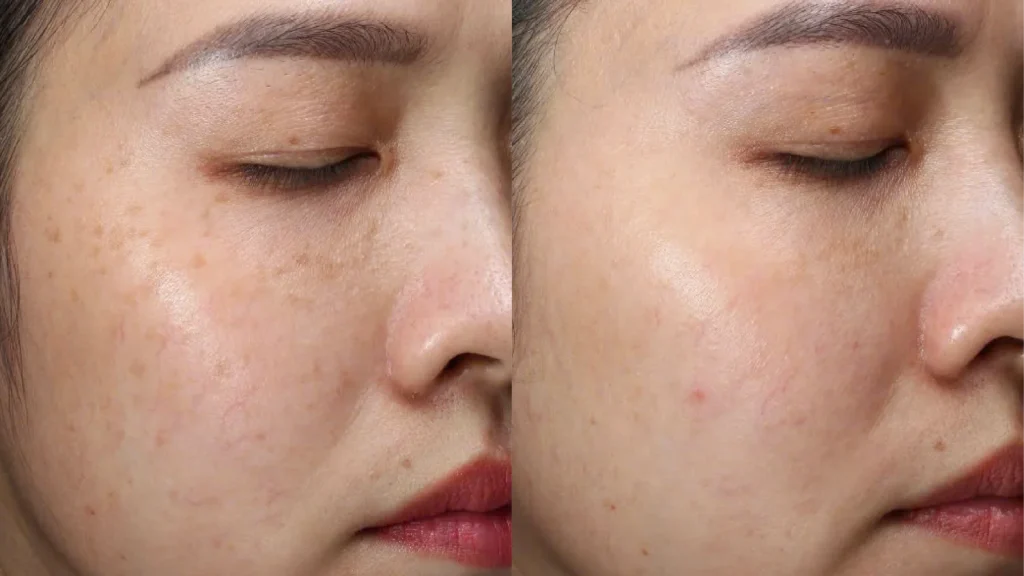 Điều trị nám da mặt cần kiên trì và theo liệu trình chuẩn để đạt kết quả bền vững.