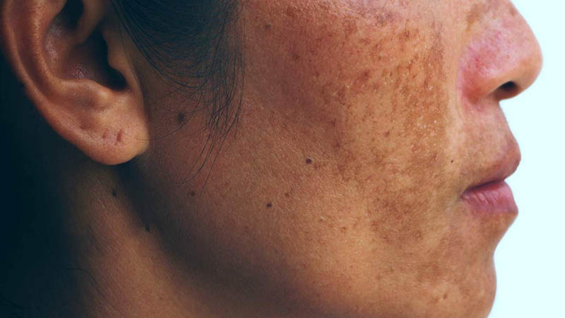 điều trị nám da mặt như thế nào để đạt hiệu quả tối ưu và an toàn?