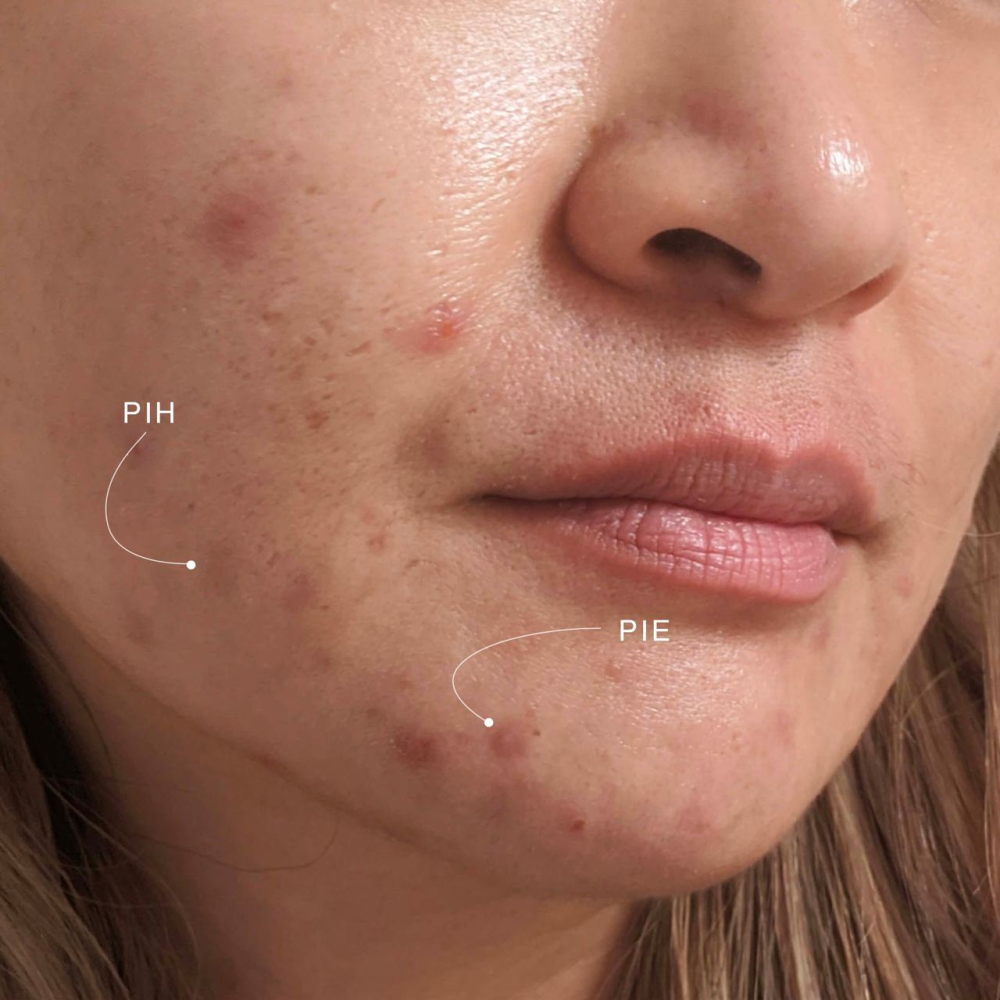 duy trì chế độ chăm sóc da dịu nhẹ, ổn định và cân bằng độ ẩm phù hợp giúp duy trì hàng rào bảo vệ tự nhiên của da, từ đó giảm thiểu nguy cơ hình thành đốm nâu